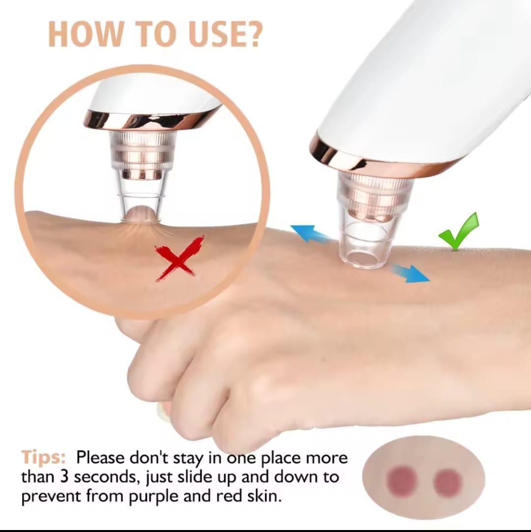 Removedor  de espinillas y limpia poros