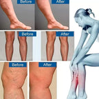 30 Parches de Varices para Circulacion