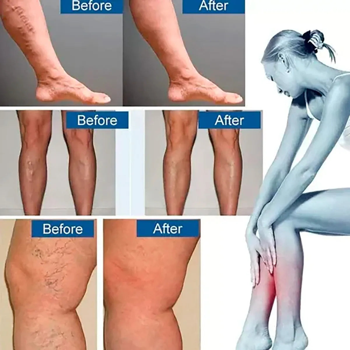 30 Parches de Varices para Circulacion